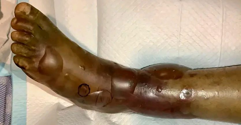 A snakebite victim's leg. Zero deaths recorded from snake bites in the country last year.