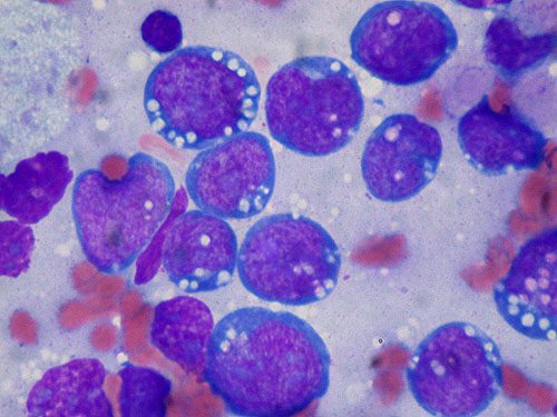 A photomicrograph of Burkitt lymphoma, touch prep, Wright stain. Copyright: Ed Uthman, MD (https://commons.wikimedia.org/wiki/File:Burkitt_lymphoma,_touch_prep,_Wright_stain.jpg).