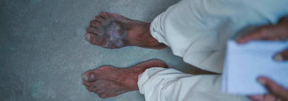 Bishnoi pushed through months of worsening pain and discharge, continuing to till his fields before he was diagnosed with eumycetoma in his right foot and had to be hospitalised. Photo credit: DNDi/ Mayank Agrawal
