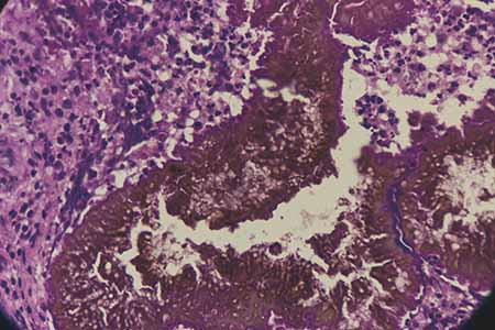 Histopathological examination of mycetoma showing fungal grains surrounded by inflammatory tissue. Samples collected and identified by Yogi Raj Joshi at his lab at Sampurnanand Medical College. Photo credit: DNDi/Mayank Agrawal