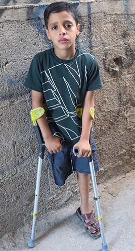 Mohammed Akram Abu Aker longs for a functional prosthesis that will allow him to run and play football without crutches just like other children. Photo Credit. Courtesy Muhammed's parents