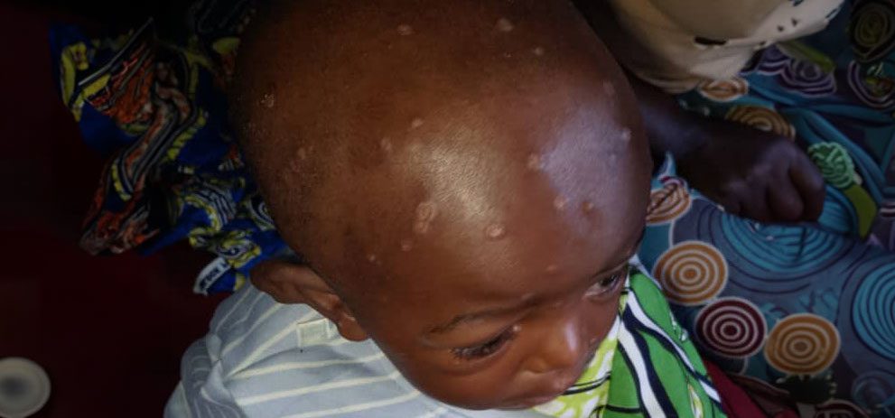 A child with mpox at Miti-Murhesa health centre in South Kivu province. Children in the Democratic Republic of Congo are still awaiting vaccines to protect them from mpox. Copyright: Moise Aganze / SciDev.Net