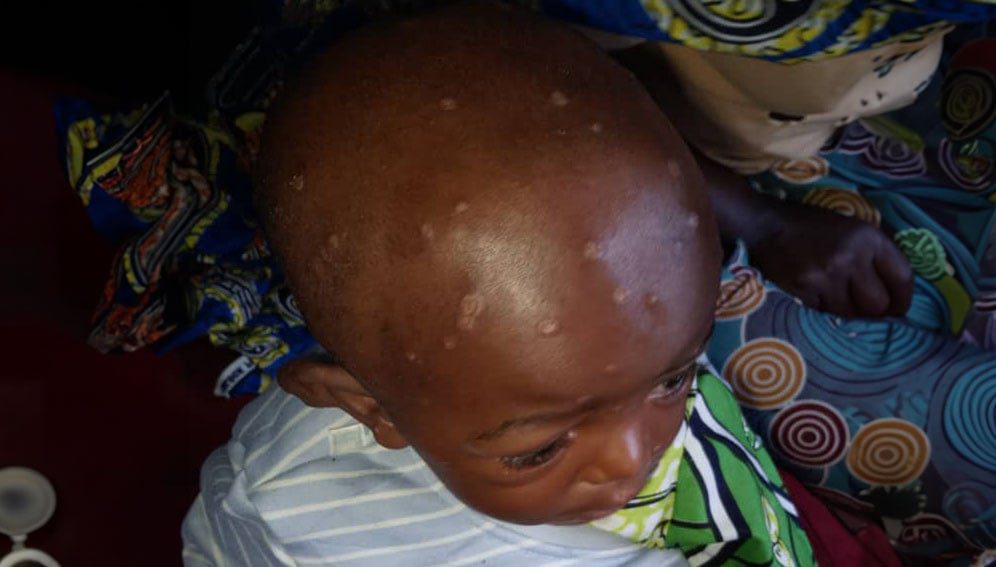 Un enfant atteint de Mpox dans le district de santé de Miti-Murhesa au Sud-Kivu