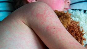 Measles vaccine push urged in Americas after World Cup