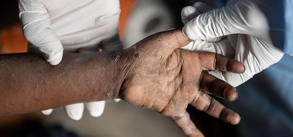 A close-up of a patient’s hand during an mpox screening consultation at the health centre supported by MSF in the Kanyaruchinya displacement site, on the outskirts of Goma. Democratic Republic of Congo, August 2024.