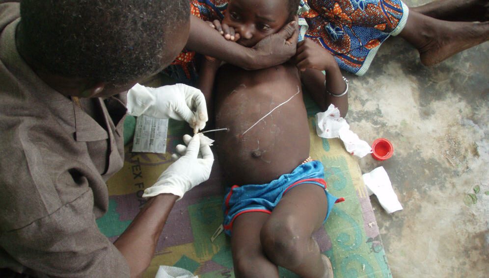 Guinea worm extraction